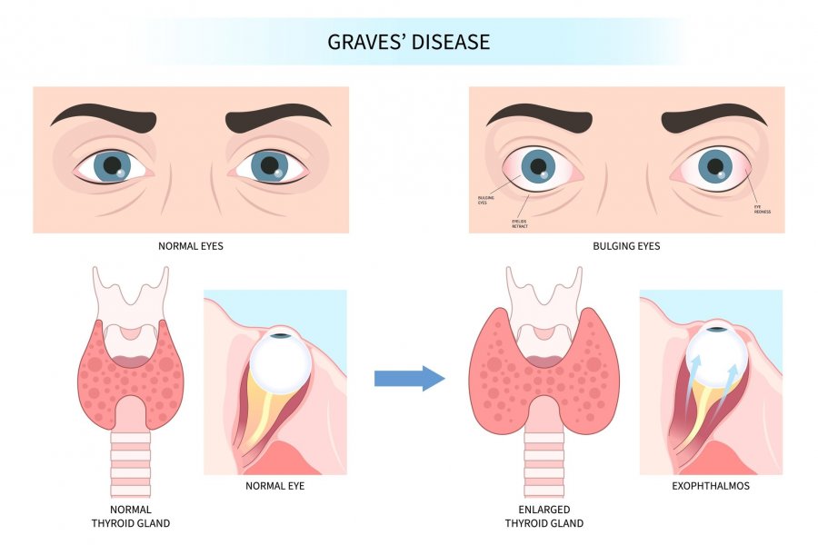 Graves Hastalığında Bütünsel Destek
